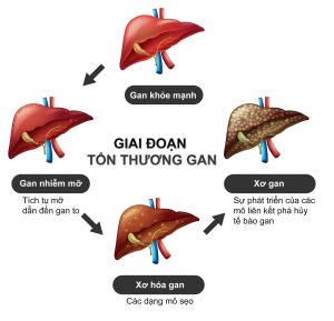 Virus viêm gan B khiến cho gan khỏe mạnh tiến triển thành xơ gan