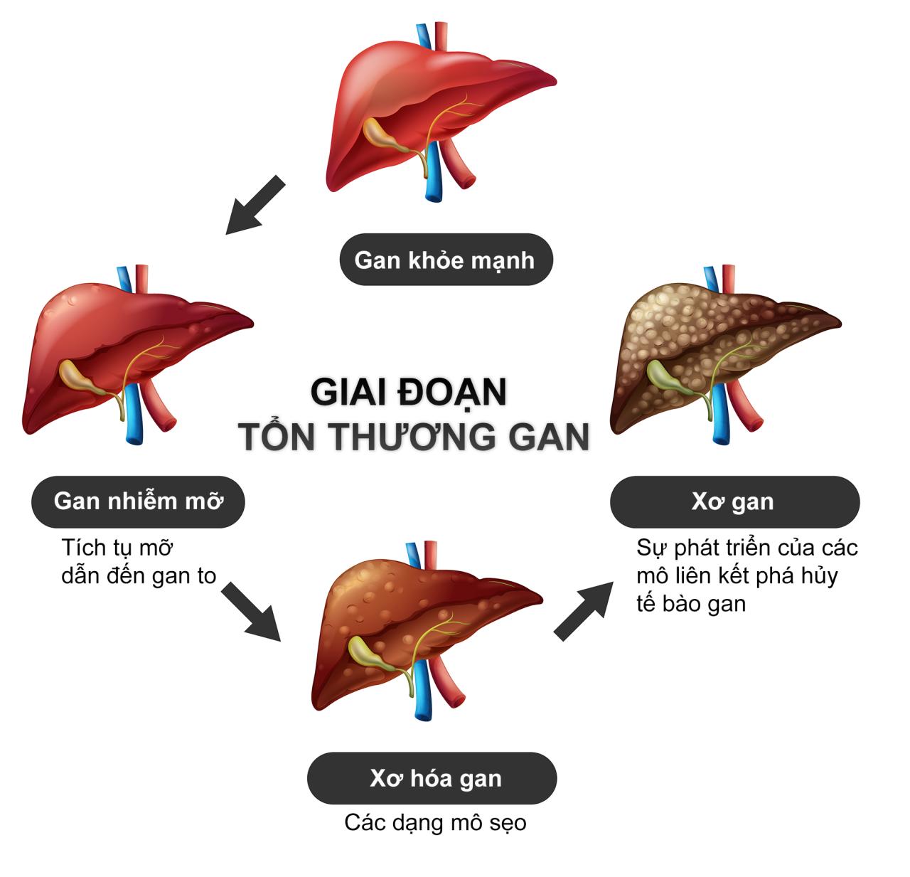 Virus viêm gan B khiến cho gan khỏe mạnh tiến triển thành xơ gan